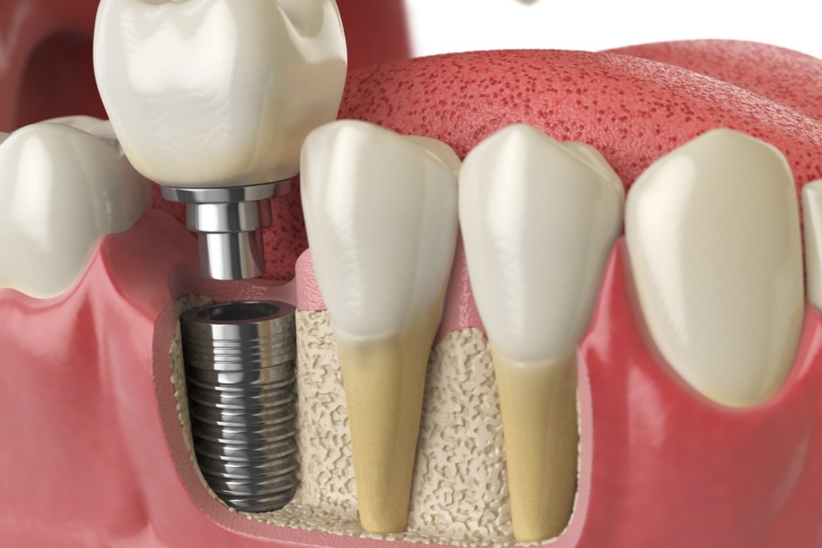 Dental Implant Service in Round Rock