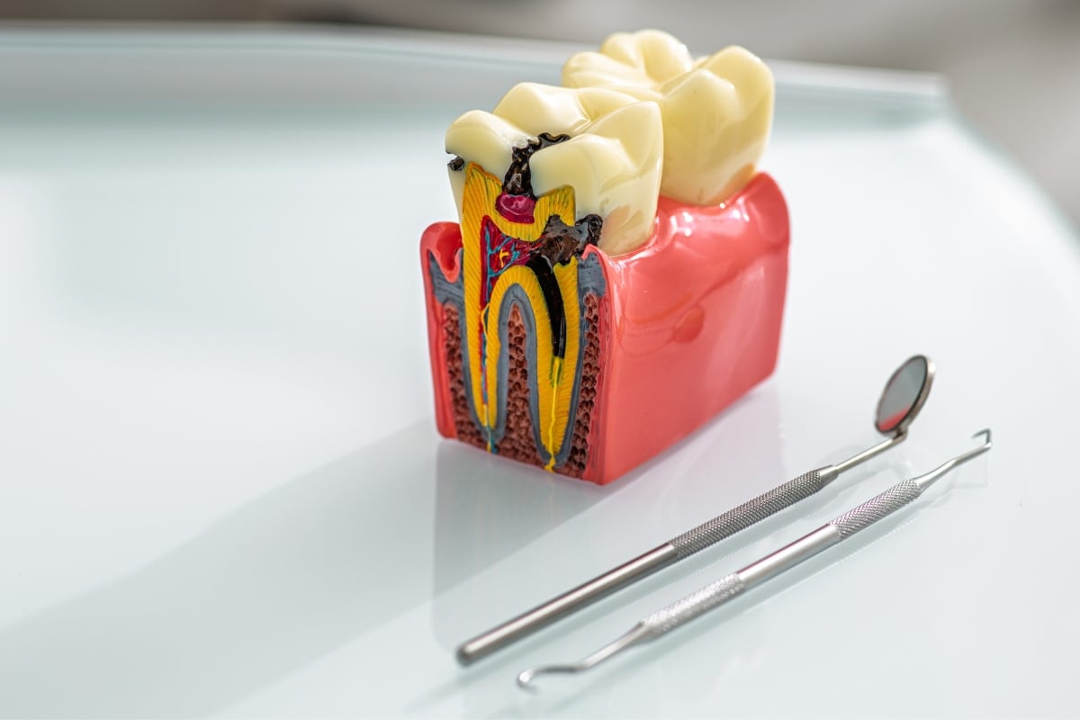 Does A Root Canal Weaken My Tooth?