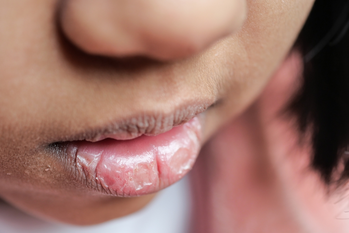 Dry Mouth Relief: The Ultimate Food & Hydration Guide