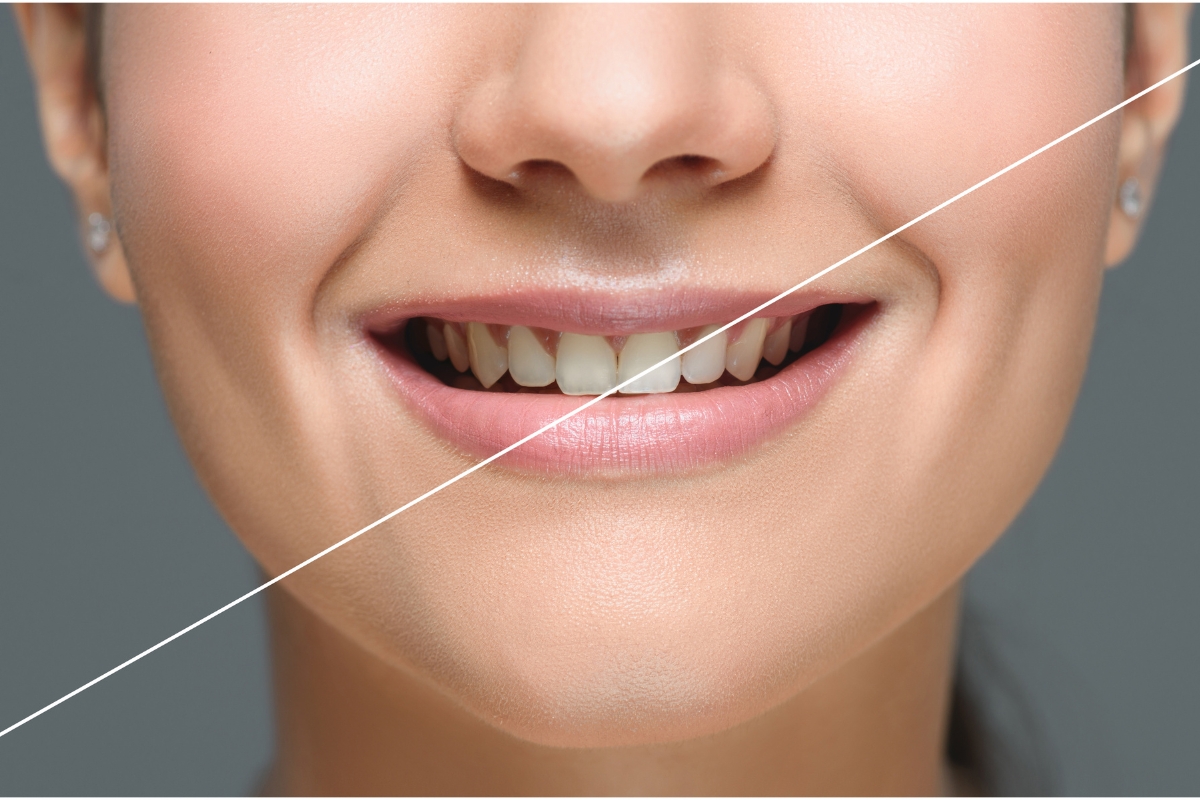 Homemade Teeth Whitening Solutions That Actually Work For Round Rock People