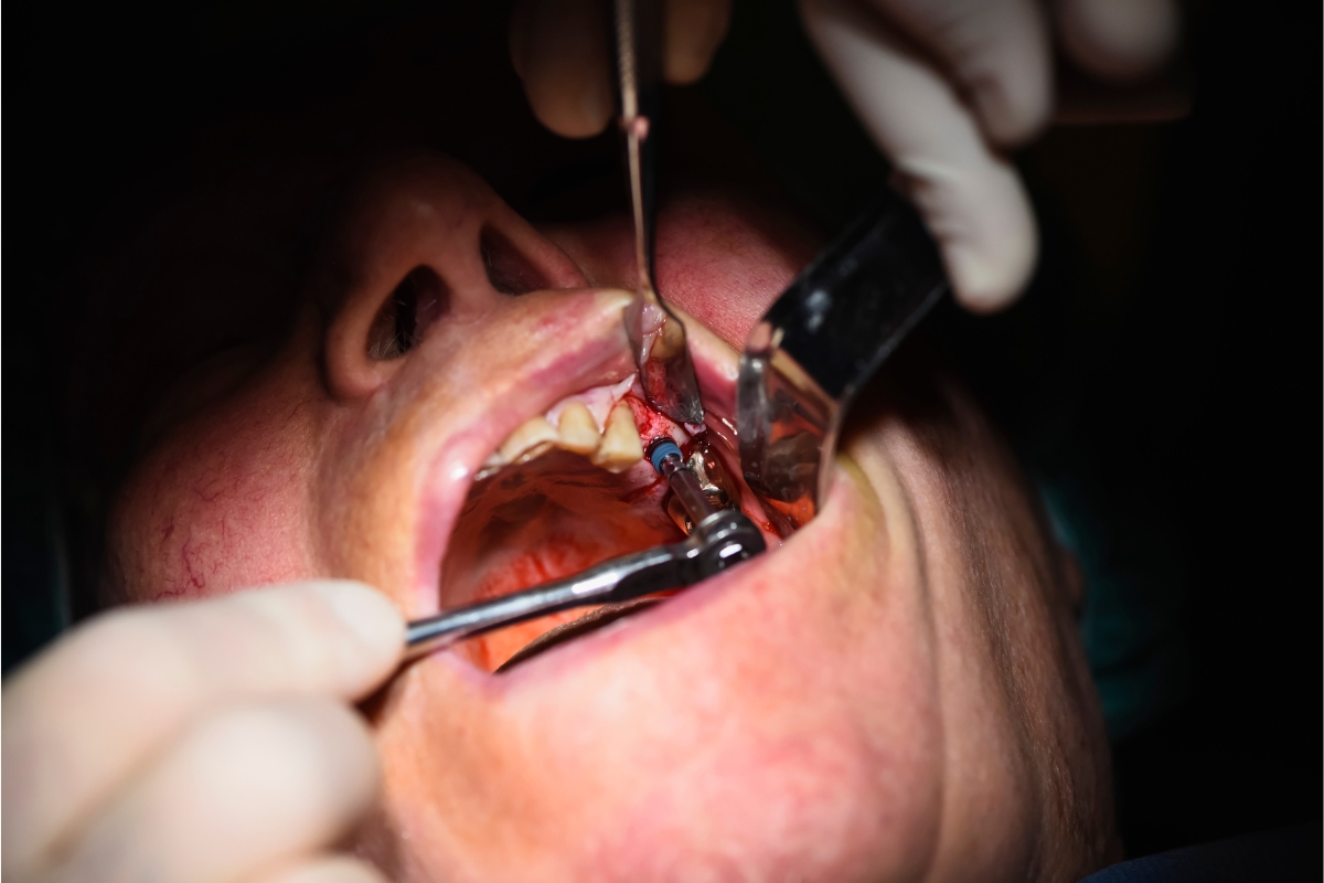 How Long Do Dental Stitches Take To Dissolve