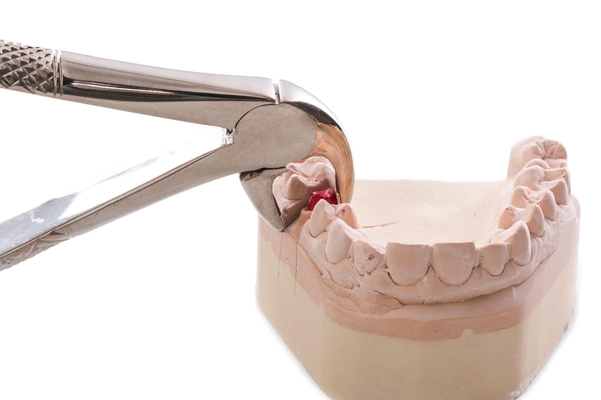 How Long Does It Take For Stitches To Dissolve After A Tooth Extraction?