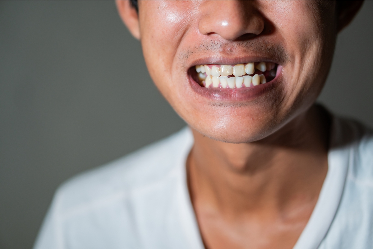 The Gap Between Your Dental Crown And Gums: How To Fix It?