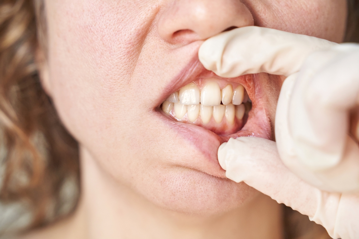 What Vitamin Deficiency Causes Enamel Erosion?