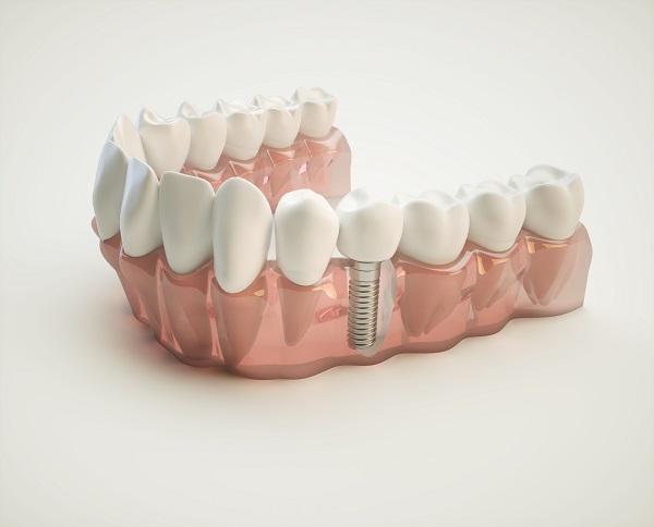 dental implants Round Rock, TX